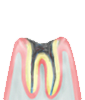 C4 歯の根っこだけが残った重度の虫歯状態。