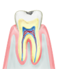 C1 表面のみの軽度の虫歯。