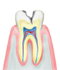 C2 象牙質まで虫歯が達した状態。