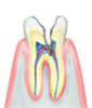 C3 歯の神経まで虫歯が進行してしまった状態。