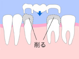 従来の治療：ブリッジ