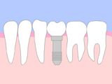 インプラント