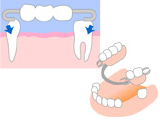 従来の治療：部分入れ歯