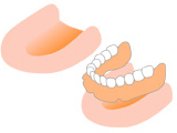 従来の治療：総入れ歯