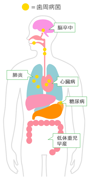 歯周病菌が関連するとされている病気